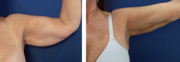 A woman's arm before and after a breast lift, showcasing the transformative effects of arm liposuction Renuvion.