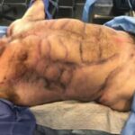 Preoperative high defintion liposuction male markings presreved during surgery