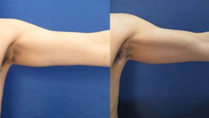 High Definition Liposuction of the Arms