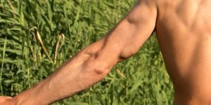 High Definition Liposuction of the Arms