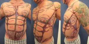 Male High Definition Liposuction Preoperative Markings