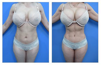 Before and after of female client demonstrating the mission of high definition liposuction.