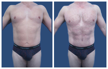 Front and back view of a man showcasing the mission of high definition liposuction.