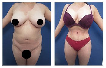 Before and after comparison of a cosmetic body surgery, questioning what is the limit of how many procedures can be done at a time.