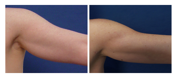 A 57-year-old female following VASER high definition liposuction and Renuvion skin tightening of the arms demonstrating elimination of under arm fat and skin redundancy with no surgical tucking.
