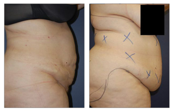 Tummy tuck before and after.