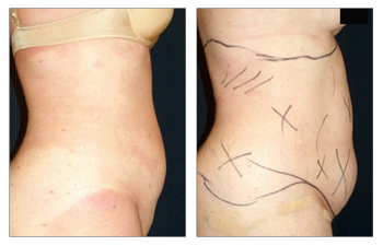 Tummy tuck before and after.