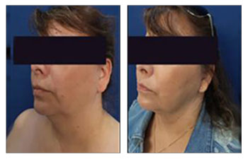 A 49-year-old female following HD Lipo and Renuvion® skin tightening of submental and jowl region.