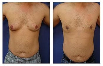 A 46-year-old male following VASER high definition liposuction of the abdomen, lateral chest, flanks and back as well as chest tapering to achieve an optimized chest appearance.