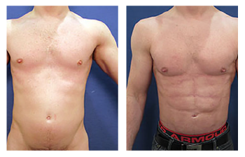 A 34-year-old male following HD liposuction of the abdomen, lateral chest, pubic region, flanks, and fat grafting to the breasts masculinize his chest appearance.