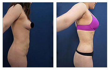 A 24-year-old female following VASER high definition liposuction of the abdomen, pubic region, and lateral chest to achieve Abdominal Etching.