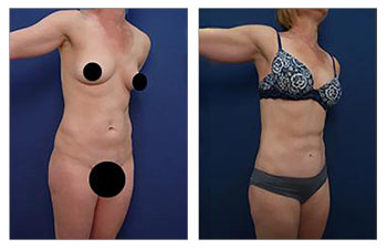 A 46-year-old female following VASER high definition liposuction of the arms, axilla, upper and lower back flanks, and abdomen to achieve Abdominal Etching.