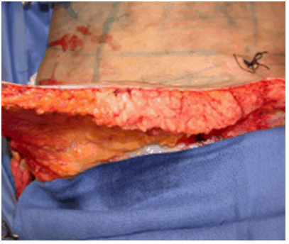 Intraoperative image demonstrating enlarged and fibrotic deep fat layer
