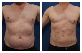 High Definition Liposuction Revision to treat paradoxical adipose hyperplasia (PAH).