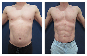 Abdominal etching can be done with high-definition liposuction