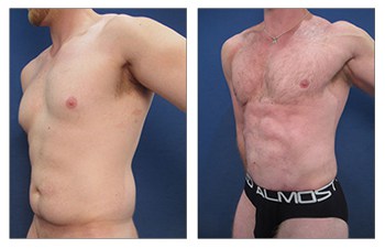 optimized chest 34 YO Left optimized chest 34 YO Left