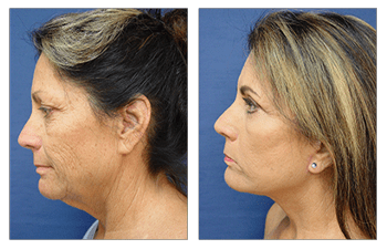 Liposuction Chin Cost Client following lipo or chin and face and neck lift.