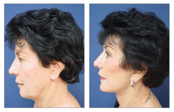 Liposuction  Chin Cost for Client who underwent liposuction of chin and facelift.