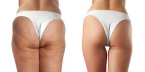 Liposuction Legs Before and After rear view