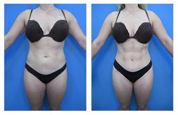 Liposuction and tummy tuck combined to create superior contour when compared to liposuction versus tummy tuck performed alone.