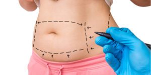 Liposuction and Tummy Tuck outline prior to surgery