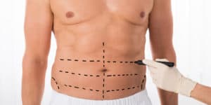 Liposuction for Men front view