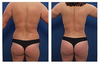Liposuction of Hips Before and After.