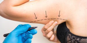 Liposuction of the Arms outline prior to surgery