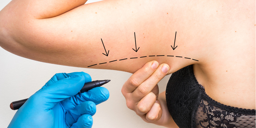 Liposuction of the Arms outline wtih planned excision prior to surgery