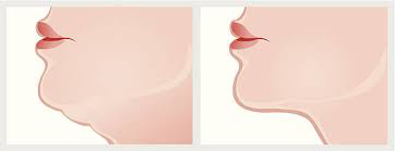 Liposuction of the chin caricature.