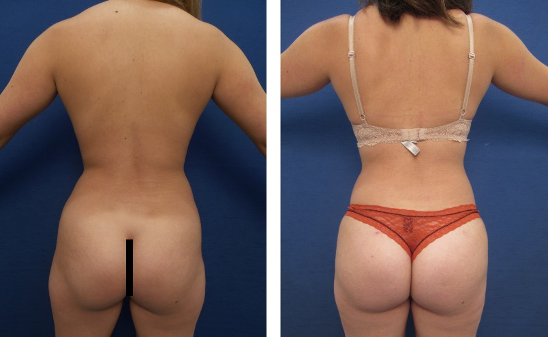 liposuction before and after results