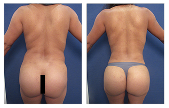 liposuction before and after results