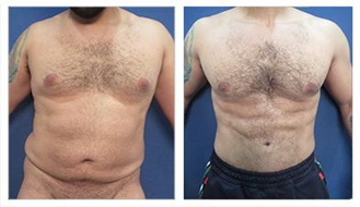 patient’s liposuction tummy before and after