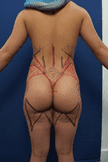 Female liposuction patients