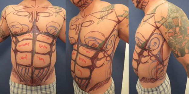 Images of Male Preoperative High Definition Liposuction markings from all viewed angles