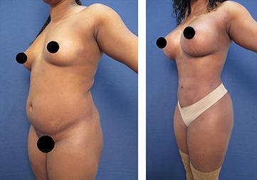 35-year-old female who had high definition liposuction of the abdomen