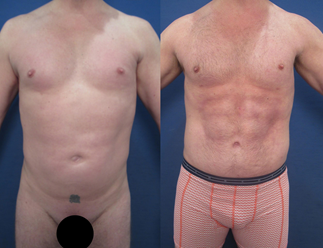 A 38-year-old male demonstrated moderate adiposity in the abdomen, mons pubis, and flanks.