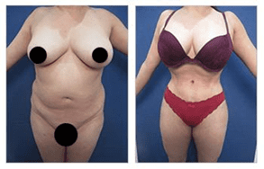 27-year-old female patient high definition VASER liposuction