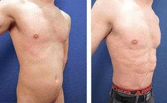 34-year-old male abdominal adiposity and minimal skin redundancy.