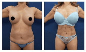 overall body aesthetic and resolve the moderate skin redundancy and adiposity in her abdomen