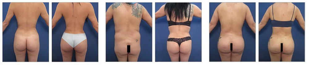 Liposuction of Hips Before and After Photos