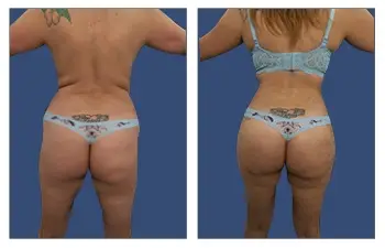 Butt Liposuction Before and after Case 1