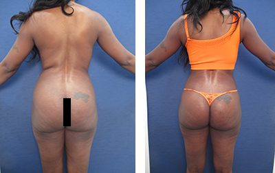 Butt Liposuction Before and after Case 2