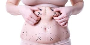 Liposuction or Tummy Tuck visual representation from the front