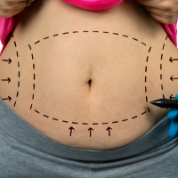 Liposuction Experience: Preoperative Planning.