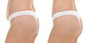 Liposuction Results visual representation from the side
