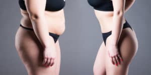 Liposuction Tummy Before and After Visual representation