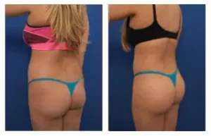 Before and after transformation following liposuction and fat transfer.