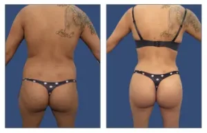 Before and after images of a client following liposuction and fat transfer.