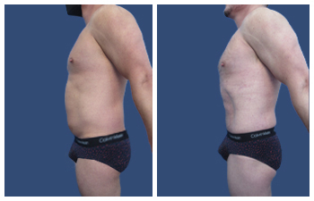 Liposuction of the Belly left lateral View.
